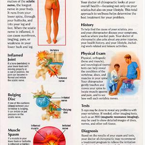 How To Sciatic Nerve Diagram - Burning Limbs: The Truth About Sciatica