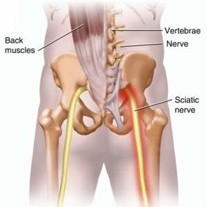 Sciatica Self Help - The Important Sciatica Stretches