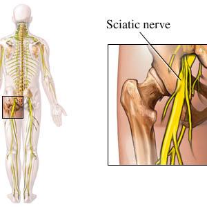 Sciatic Nerve Entrapment - Different Type Of Exercises