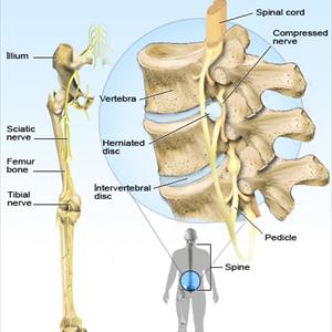 Sciatica Cures - Sciatica Treatment By Physiotherapists