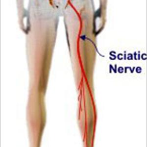 Sciatic Treatment - The Important Sciatica Stretches