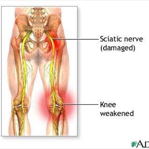 Sciatic Block Posterior Approach - Pain Relief | Do You Know The Causes Of Sciatica Nerve Pain?