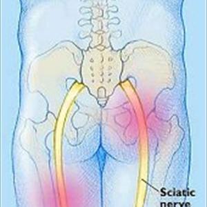 Back Sciatica Information - Proper Sciatica Exercises To Reduce Sciatica Pain