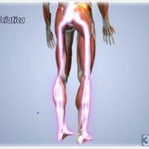 Back Sciatica Blogs - How Can Magnetic Therapy Relieve Sciatica?